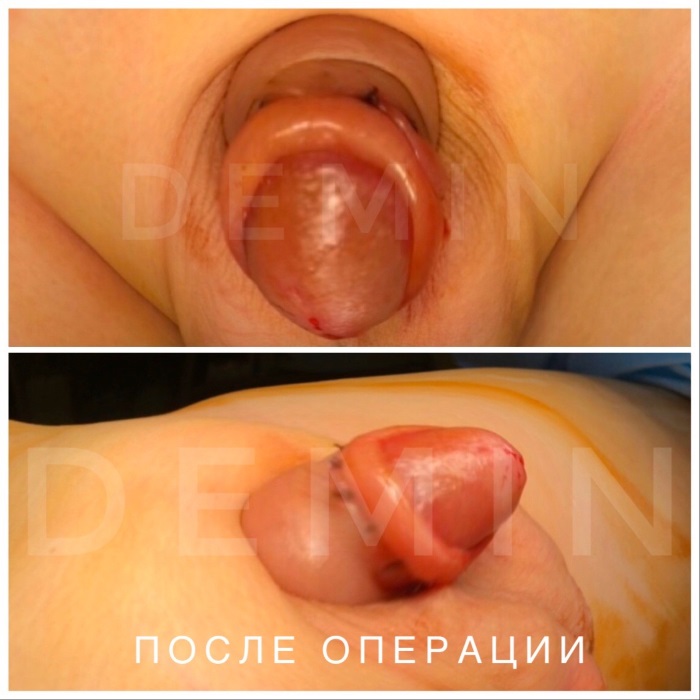 Гипоспадия - оперирует Никита Валерьевич
